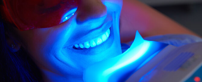 Hollywood Smiles Unveiled: Professional vs At-Home Whitening