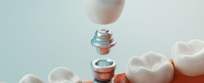 Dental Implants vs. Dentures: Which Is Right for You?