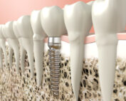 Dental Implants: Enjoy Your Favorite Foods Again!