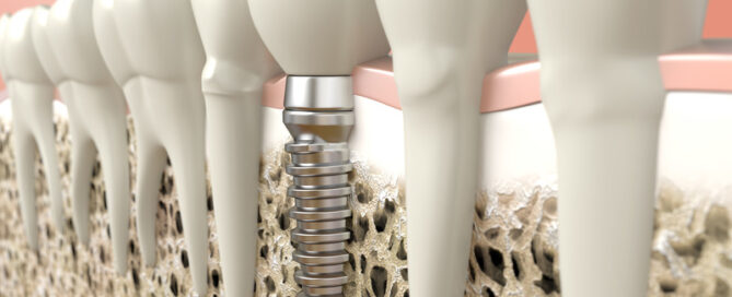 Dental Implants: Enjoy Your Favorite Foods Again!