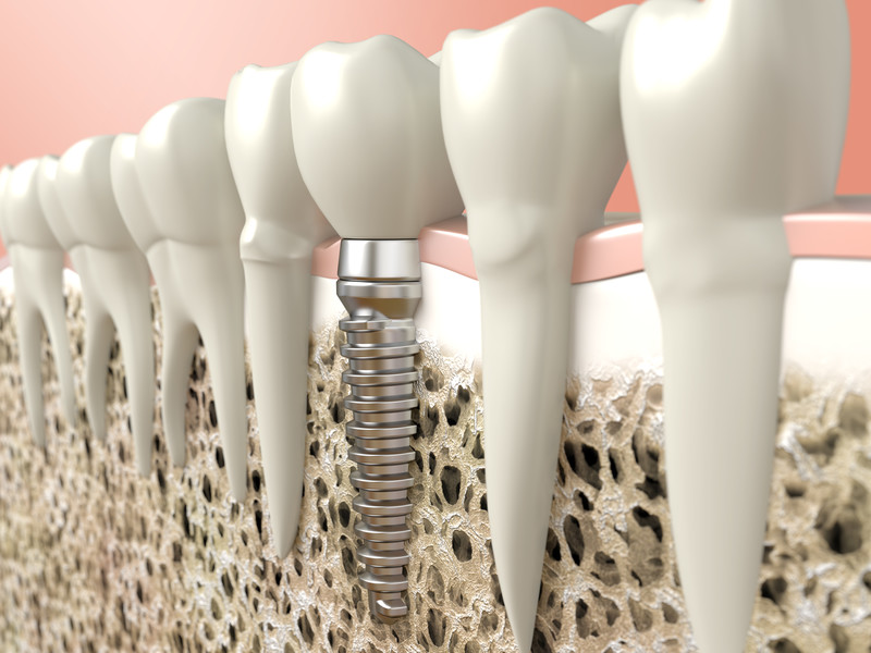 Dental Implants: Enjoy Your Favorite Foods Again!