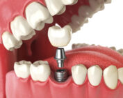 Navigating Dental Implant Options: Your Guide to Smiling
