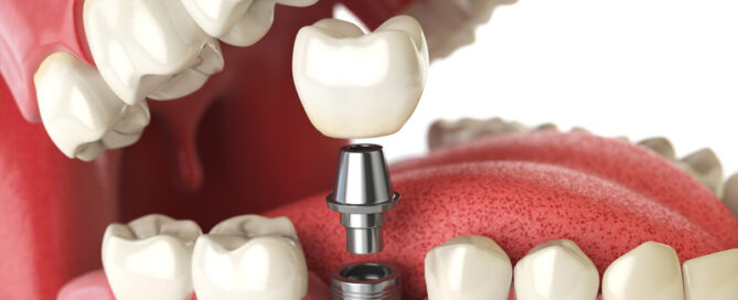 Navigating Dental Implant Options: Your Guide to Smiling