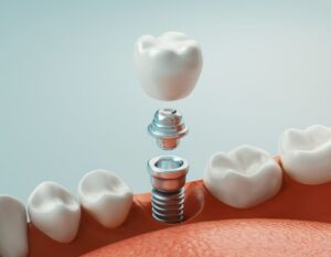 Dental Implants: Your Journey to a Restored Smile same day dental implants scottsdale az