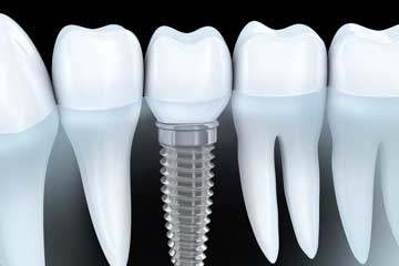 single implants scottsdale